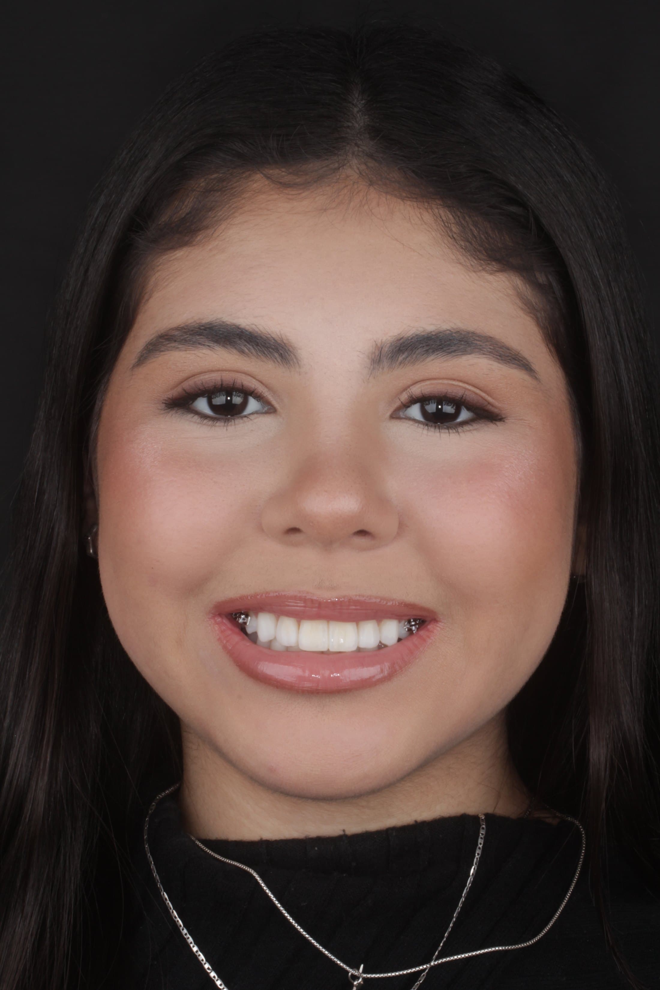 Clinical case 4 by Dr. Jaqueline Amadeu Merino — After
